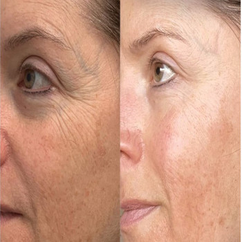 Ботулотоксин периорбітальної зони (очі, гусячі лапки)
                    Косметологічний центр  Ужгород