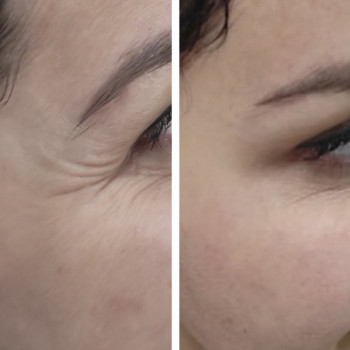 Ботулотоксин периорбітальної зони (очі, гусячі лапки)
                    Косметологічний центр  Ужгород