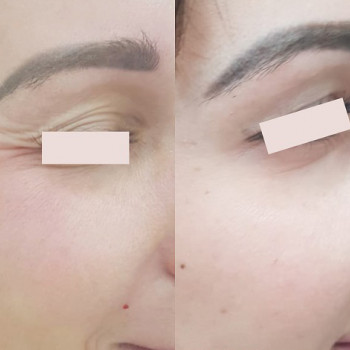 Ботулотоксин периорбітальної зони (очі, гусячі лапки)
                    Косметологічний центр  Ужгород