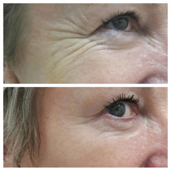 Ботулотоксин периорбітальної зони (очі, гусячі лапки)
                    Косметологічний центр  Ужгород