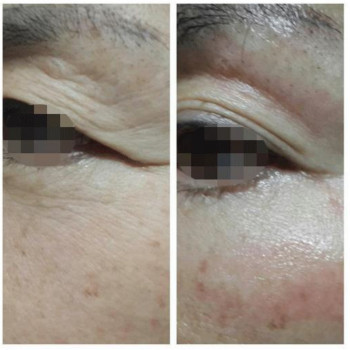 Ботулотоксин периорбітальної зони (очі, гусячі лапки)
                    Косметологічний центр  Ужгород