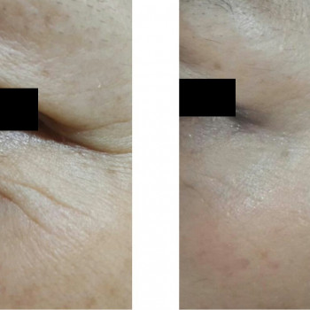 Ботулотоксин периорбітальної зони (очі, гусячі лапки)
                    Косметологічний центр  Ужгород