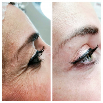 Ботулотоксин периорбітальної зони (очі, гусячі лапки)
                    Косметологічний центр  Ужгород