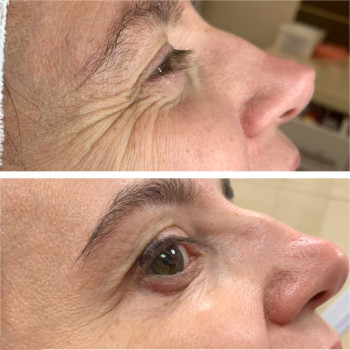 Ботулотоксин периорбітальної зони (очі, гусячі лапки)
                    Косметологічний центр  Ужгород