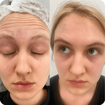 Ботулотоксин чола
                    Косметологический центр  Ужгород