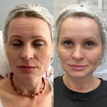 Ботулотоксин Full face
                    Косметологічний центр  Ужгород