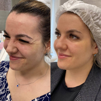 Ботулотоксин Full face
                    Косметологічний центр  Ужгород