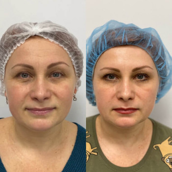 Ботулотоксин Full face
                    Косметологічний центр  Ужгород