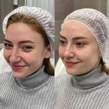 Ботулотоксин Full face
                    Косметологічний центр  Ужгород