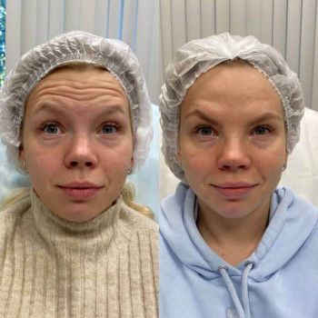 Ботулотоксин Full face
                    Косметологічний центр  Ужгород