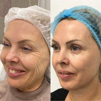 Ботулотоксин Full face
                    Косметологічний центр  Ужгород