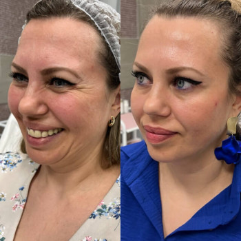 Ботулотоксин Full face
                    Косметологічний центр  Ужгород