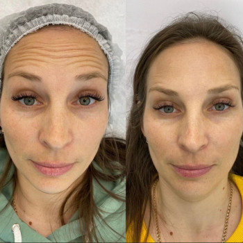 Ботулотоксин Full face
                    Косметологічний центр  Ужгород