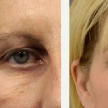 Полімолочна кислота
                    Косметологический центр  Ужгород