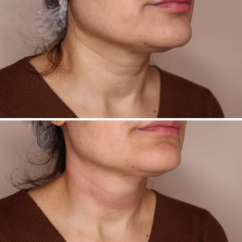 Полімолочна кислота
                    Косметологический центр  Ужгород