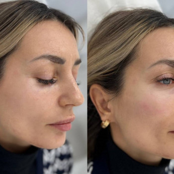 Полімолочна кислота
                    Косметологический центр  Ужгород