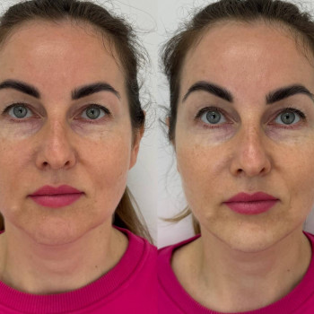 Полімолочна кислота
                    Косметологический центр  Ужгород