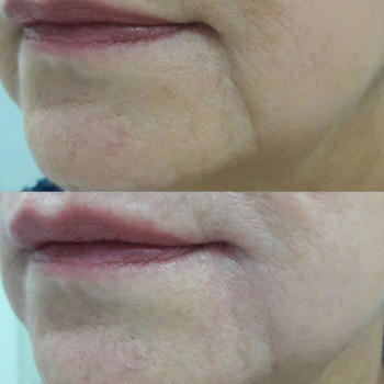 Полімолочна кислота
                    Косметологический центр  Ужгород