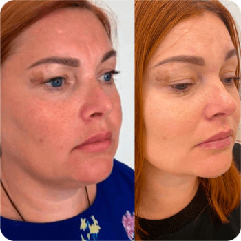 Полімолочна кислота
                    Косметологический центр  Ужгород