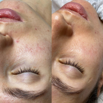 Пілінг AHA+BHA кислоти
                    Косметологический центр  Ужгород