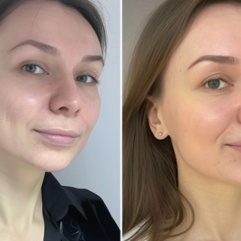 Пілінг AHA+BHA кислоти
                    Косметологический центр  Ужгород