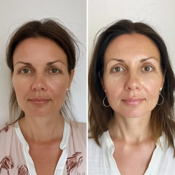 Програма для зрілої проблемної шкіри
                    Косметологический центр  Ужгород