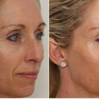 Освітлююча  програма від пігментації
                    Косметологічний центр  Ужгород