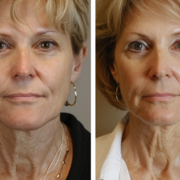 Міофасціальний масаж
                    Косметологический центр  Ужгород