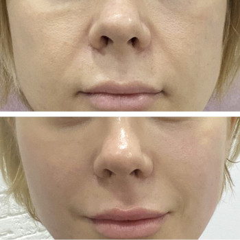 Скульптурно-буккальный масаж
                    Косметологический центр  Ужгород