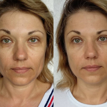 Скульптурно-буккальный масаж
                    Косметологический центр  Ужгород