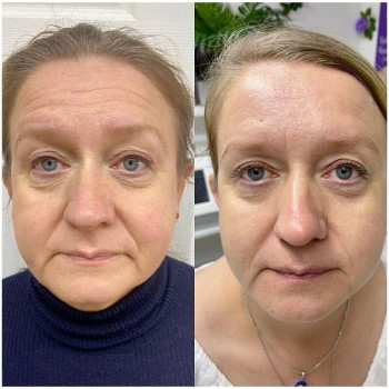 Пластичний масаж обличчя
                    Косметологічний центр  Ужгород