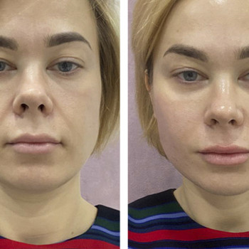 Пластичний масаж обличчя
                    Косметологічний центр  Ужгород