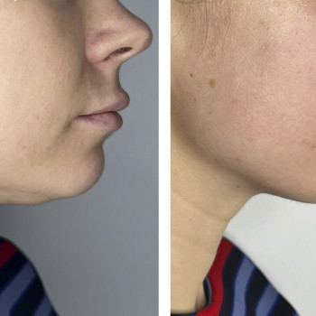 Пластичний масаж обличчя
                    Косметологічний центр  Ужгород