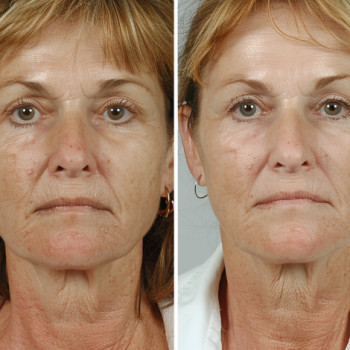 Точковий масаж обличчя
                    Косметологический центр  Ужгород