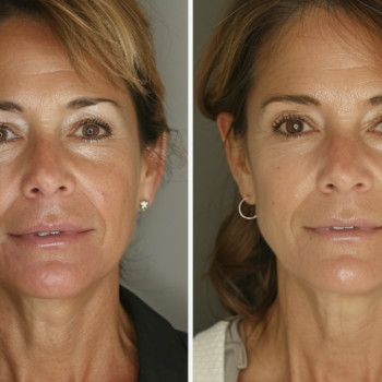 Точковий масаж обличчя
                    Косметологический центр  Ужгород