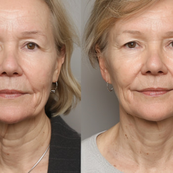 Точковий масаж обличчя
                    Косметологический центр  Ужгород