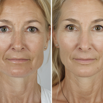 Голд маска з часточками золота
                    Косметологічний центр  Ужгород