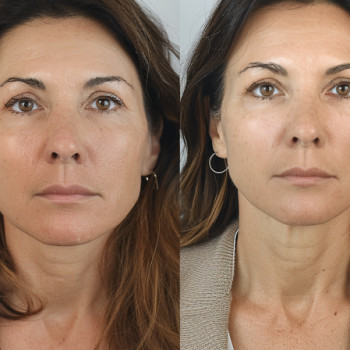 Кавова маска - ексфоліант
                    Косметологічний центр  Ужгород