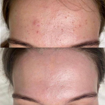 Комбінована чистка
                    Косметологический центр  Ужгород