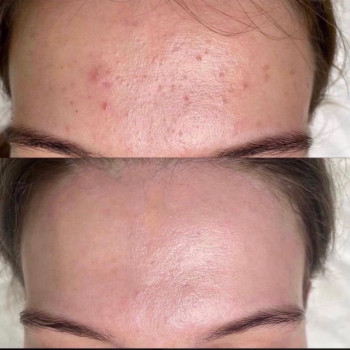 Комбінована чистка
                    Косметологический центр  Ужгород