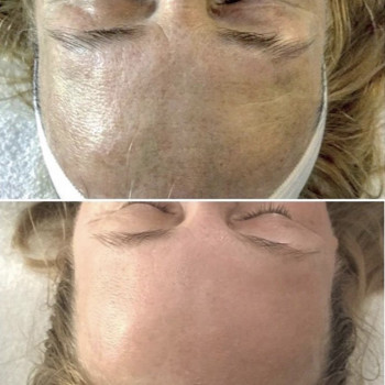 Комбінована чистка
                    Косметологический центр  Ужгород