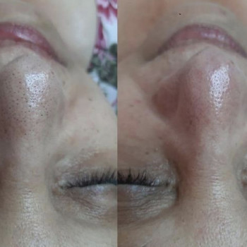 Комбінована чистка
                    Косметологический центр  Ужгород