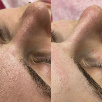 Атравматична чистка
                    Косметологический центр  Ужгород