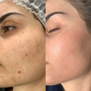 Атравматична чистка
                    Косметологический центр  Ужгород