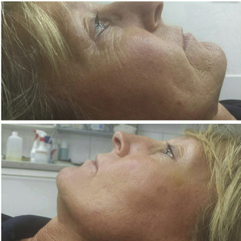 Мікроголковий РФ ліфтинг + Полікапролактон (PLC)
                    Косметологический центр  Ужгород