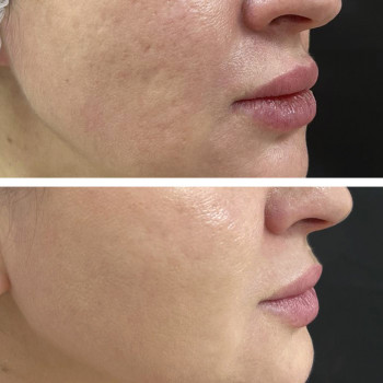 Мікроголковий РФ ліфтинг + Полікапролактон (PLC)
                    Косметологический центр  Ужгород