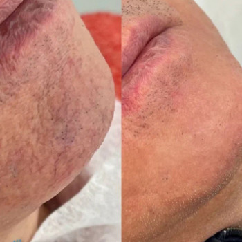 Мікроголковий РФ ліфтинг + Полікапролактон (PLC)
                    Косметологический центр  Ужгород