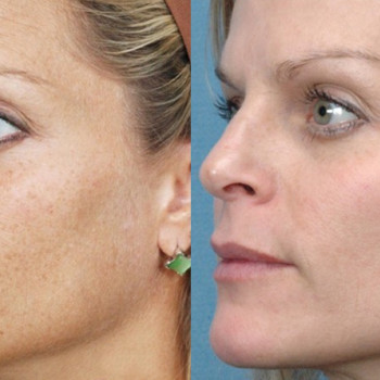 Мікроголковий РФ ліфтинг + Полікапролактон (PLC)
                    Косметологический центр  Ужгород