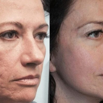 Мікроголковий РФ ліфтинг + Полікапролактон (PLC)
                    Косметологический центр  Ужгород