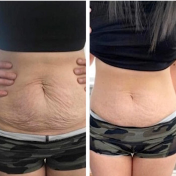 Мікроголковий РФ ліфтинг + Полікапролактон (PLC)
                    Косметологический центр  Ужгород